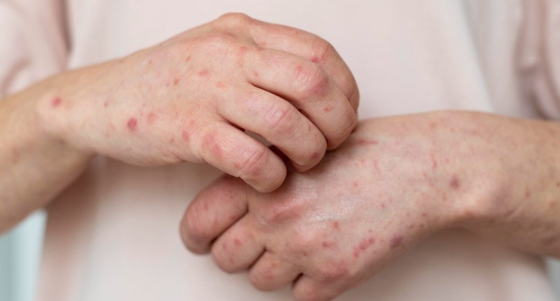 CASOS DE SARAMPIÓN EN MÉXICO DURANTE 2026 YA SUPERAN EL TOTAL DEL AÑO PASADO